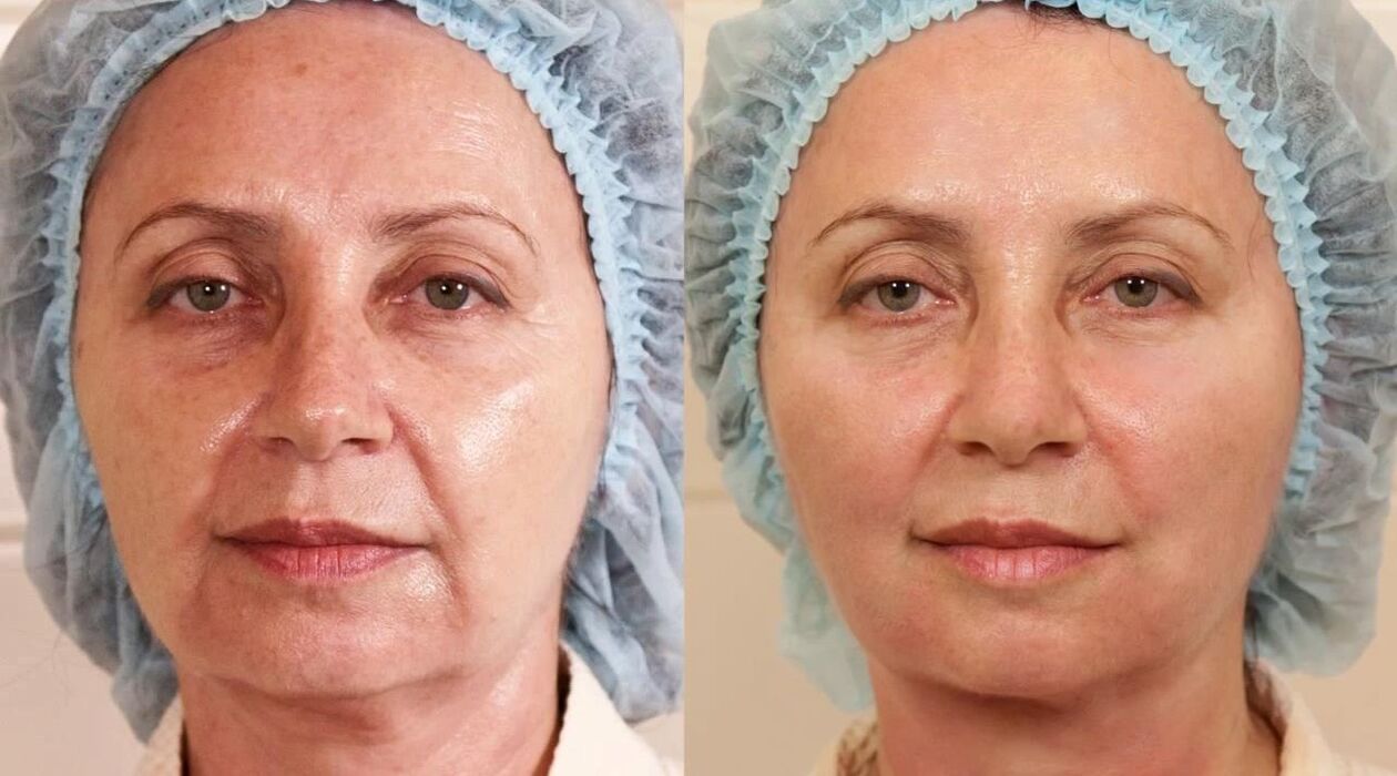 Fotos del antes y después del lifting facial
