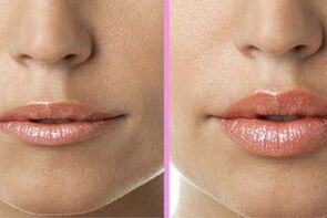 antes y después de la restauración de labios